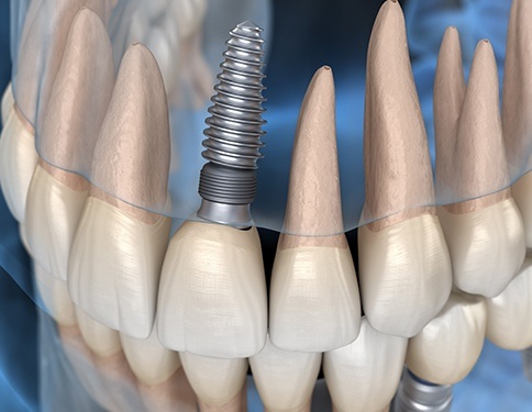 3D animated implant supported dental crown