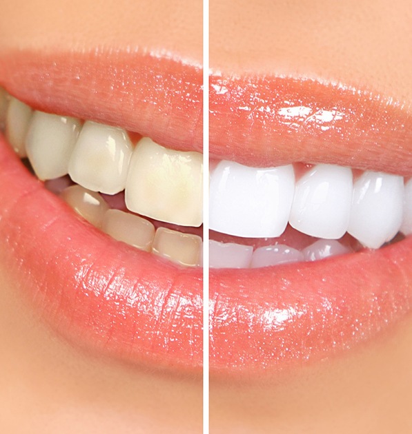 Closeup before and after teeth whitening in tyler