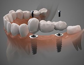 Dental bridge about to be attached to implants